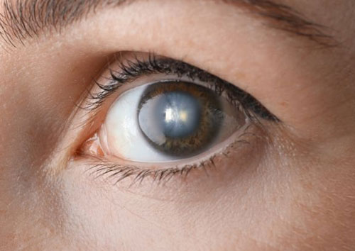 Early Signs of Cataracts