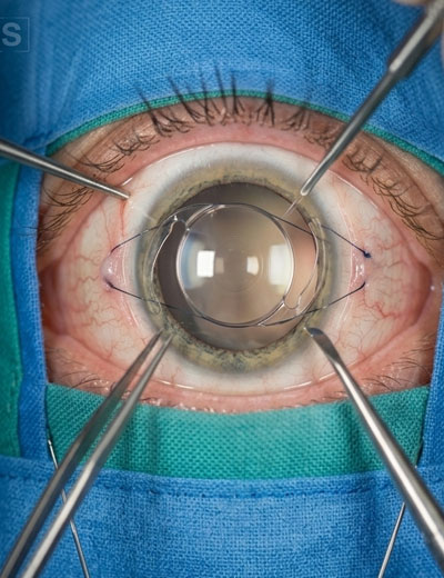 Scleral Fixated IOL (SFIOL)